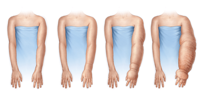 Etapas del linfedema en el brazo