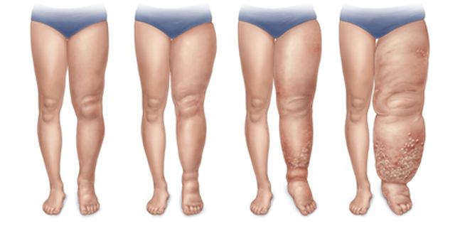 Etapas del linfedema en la pierna