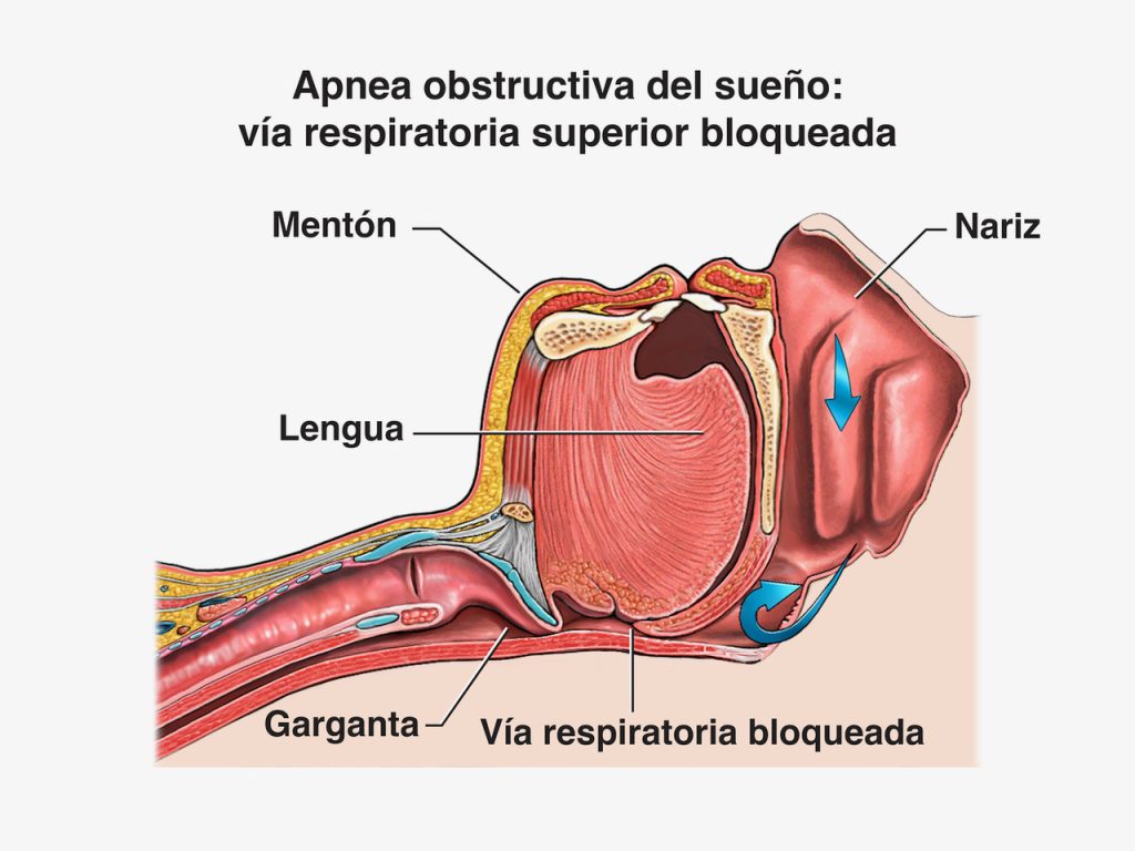 Ilustración de la apnea obstructiva del sueño